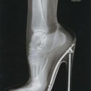 X-Ray of Foot In High Heels